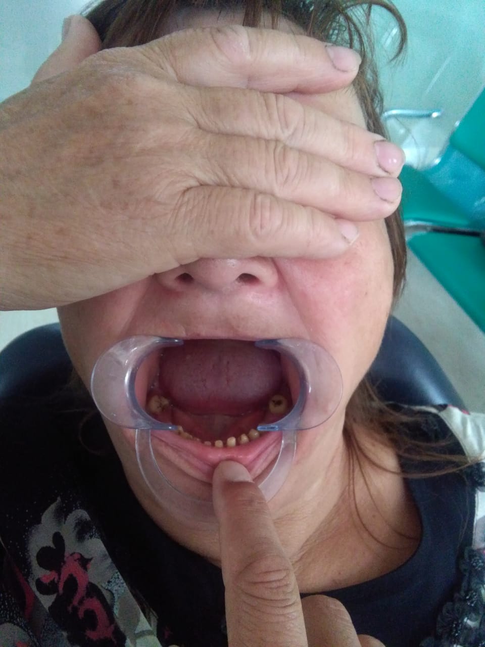 до и после вставить зубы в Китае